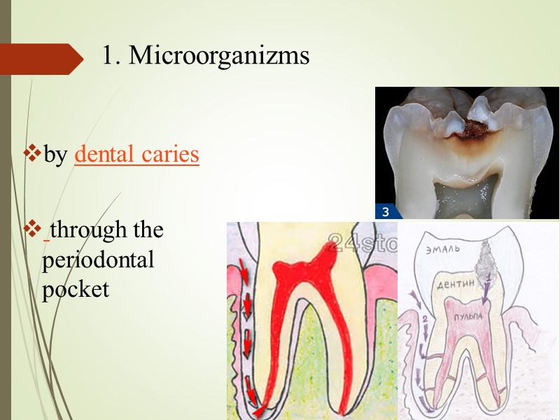 by dental caries   through the periodontal pocket 1. Microorganizms